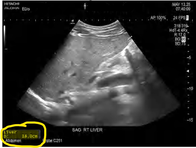 ultrasound of saggital liver dimension measurement of 18.0cm 