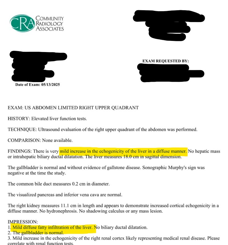 Ultrasound technician notes indicating mild diffuse fatty infiltration of the liver and liver measurement of 18.0cm in sagittal dimension
